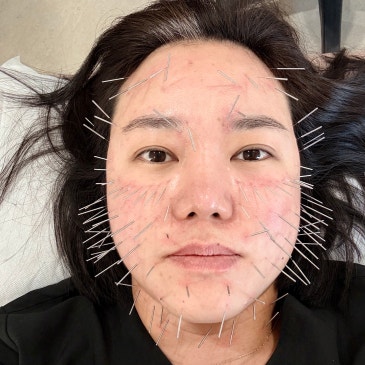보람동50대피부탄력 관리, 인위적인 시술 대신 ‘정안침’을 선택하는 이유 대표 이미지