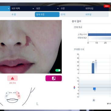 세종필러 팔자주름 때문에 고민된다면 매선리프팅으로